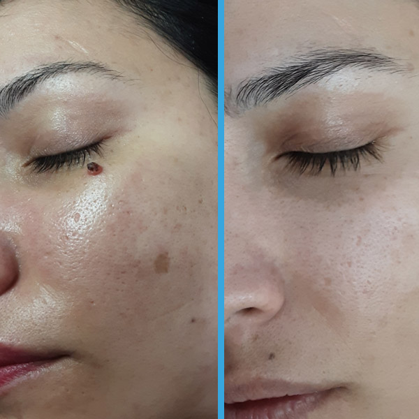 Before and after — A lesion next to the eye